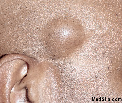 Липома
